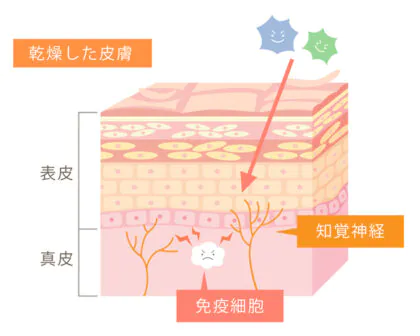 アトピー性皮膚炎｜仙台市若林区